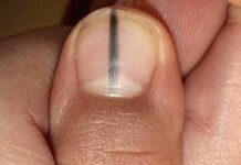 5 dấu hiệu trên móng tay cảnh báo bệnh nan y: Có 1 trong 5 dấu hiệu cũng nên đi khám gấp