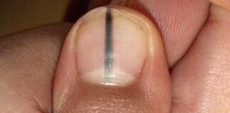5 dấu hiệu trên móng tay cảnh báo bệnh nan y: Có 1 trong 5 dấu hiệu cũng nên đi khám gấp